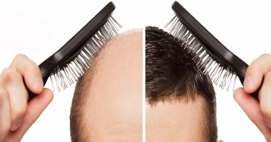 زراعة الشعر.. اعرف تفاصيل إجراء العملية بالاقتطاف "FUE" من دكتور محمد عماد