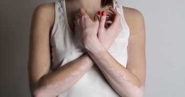 اعراض البهاق وعلاماته الرئيسية واسبابه 