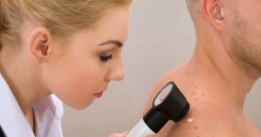 أسباب حبوب الظهر أهمها التعرض لمواد كيميائية