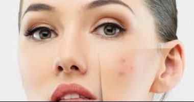 مش محتاجة مصاريف.. هكذا تتخلص من آثار حب الشباب فى المنزل