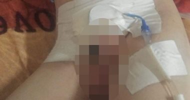 تعرف على مطلب أسرة طفل المنوفية المبتور عضوه من وزير الصحة