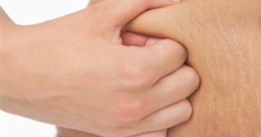العناية بالجسم.. تخلصى من الاستريتش ماركس فى "3 خطوات"