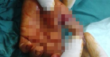 أطباء بالشرقية ينجحون فى إعادة توصيل إصبع طفل بعد بتره 