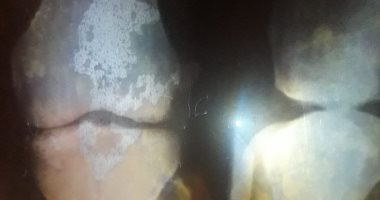  قارئ يستغيث لمساعدته فى إجراء عملية رباط صليبى لابنه على نفقة الدولة 