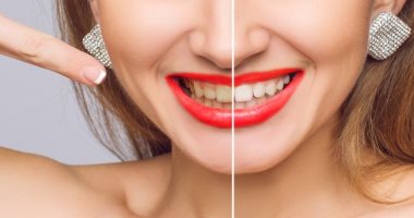 اسباب اصفرار الأسنان منها بعض الأدوية
