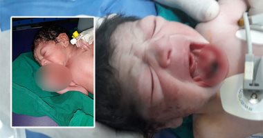 أب يستغيث لعلاج طفلته تعانى عيوب خلقية بالقلب فى الغربية.. ووكيل الصحة يستجيب