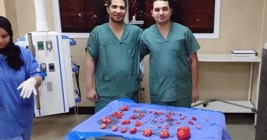 صور.. جراحة نادرة لاستخراج 45 ورم ليفى من رحم سيدة تعانى العقم فى بنى سويف 