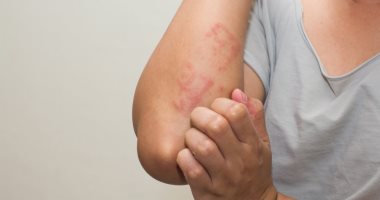 س وج.. كل ما تريد معرفته عن أسباب وأعراض الإكزيما
