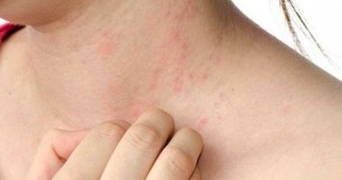 اعراض حساسية القمح ونصائح لعلاجها