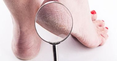 انسى الكعب المشقق.. استخدمى النعناع والفازلين فى العناية بالجسم لبشرة ناعمة