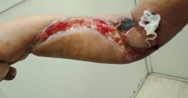 صور.. من ينقذ الطفلة فرح ضحية الإهمال الطبى.. والدتها تطالب بعلاجها