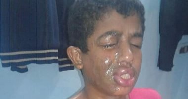 مباحث كفر صقر تكثف جهودها للقبض على المتهمين بتشويه شقيقين بمياة نار