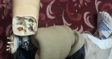 قارئ يناشد وزارة الصحة لشراء جهاز تعويضى لقدمه اليسرى