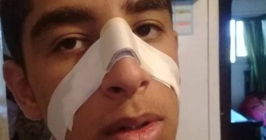 طالب ثانوى بالشرقية يضرب زميله ويتسبب فى كسر أنفه داخل المدرسة