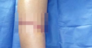 فريق طبى بجامعة الأزهر ينجح فى إعادة ساعد مبتور بمستشفى دمياط الجامعى