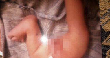 مأساة طفلة بالغربية ولدت بتشوهات جسدية.. ووالدها يتهم الطبيب بالإهمال