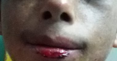 صور.. محمد يبكى ولا ينام.. مصاب بمرض جلدى نادر والده يستغيث لإنقاذه