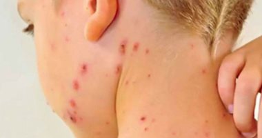منظمة أنقذوا الأطفال: بنجلاديش تواجه أسوأ تفشٍ للحصبة منذ عقد من الزمان