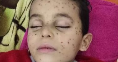 صور.. طفل مريض بسرطان الدم "بين الحياة والموت" وأسرته تطالب بعلاجه