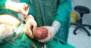 صور.. أطباء مستشفى الأقصر ينجحون فى استئصال ورم يزن 5 كيلو من رحم سيدة