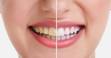 س وج.. كل ما تريد معرفته عن تبييض الأسنان بطرق طبيعية 