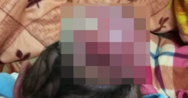 طفل يولد بورم متصل بالمخ خارج رأسه.. وقارئة تناشد "المسئولين" بتبنى علاجه