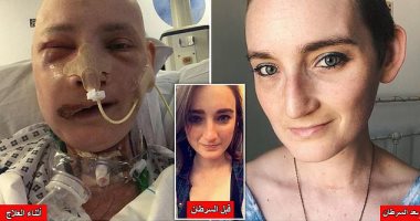 التفاصيل الكاملة لإعادة بناء وجه امرأة من عظام الكتف بعد نوع سرطان نادر.. صور