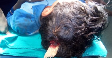 صور.. عرق خشبى يخترق رأس طفل.. وأطباء مستشفى الأقصر الدولى ينقذون حياته