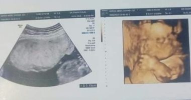 قارئ يستغيث بوزيرة الصحة للكشف على زوجته وجنينها الذى يعانى تشوهات خلقية