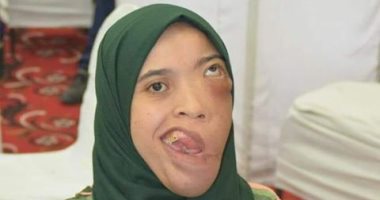 قارئة تطالب بعلاجها على نفقة الدولة بجراحة عاجلة من ورم ليفى بالوجه والفكين