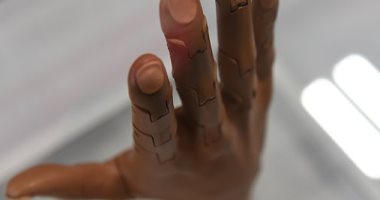 تقنية جديدة تعيد الإحساس بالحرارة والبرودة فى الأطراف الوهمية لمبتورى الأطراف