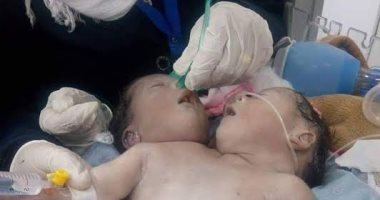 وفاة توأم  "ملتصق " بعد ساعات من ولادتهما بالشرقية