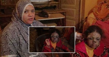 صور.. الشمس تحرق سلمى وتذيب جلدها.. طفلة سوهاجية تعانى من مرض غريب وتجرى 5 عمليات جراحية دون جدوى.. فقدت جزءا من أنفها والأطباء يختلفون فى تشخيص حالتها.. وتبكى: محدش بيلعب معايا والأطفال بيعايرونى ونفسى اتعالج