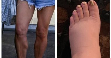جيسيكا سمبسون تشارك فى تحدى الـ10 سنوات بصور قدمها متورمة.. إيه السبب؟