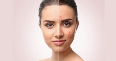 وصفات طبيعية لعلاج آثار حب الشباب .. جربيها