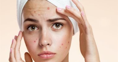 5 وصفات طبيعية لعلاج حب الشباب