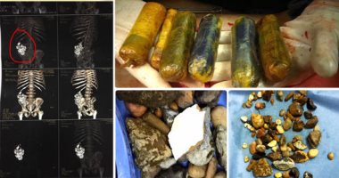 عجائب وغرائب الطب.. تفاصيل استخراج زلط وسيراميك وأكياس بلاستيك من بطن مسن بمستشفى أسيوط الجامعى.. الأطباء: المريض اشتكى من انتفاخ وفوجئنا بكميات من الطوب.. وهذه أغرب أشياء استخرجناها من بطون المرضى.. صور