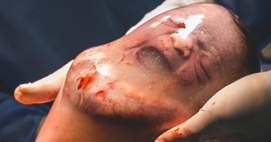 "نزل بكيسه".. أغرب حالة ولادة فى البرازيل × 7 صور