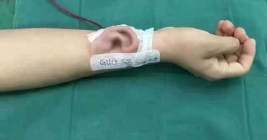 كله بالعلم.. طبيب صينى يزرع أذنًا بذراع مريض.. ونجاح إعادة ذراع أمريكية بعدما فقدته فى حادث.. وشاب يخضع لـ 51 جراحة لتحويله لشخصية خيالية.. وإصلاح لسان سيدة بقطعة من جسدها بعد فقدانه لإصابتها بالسرطان