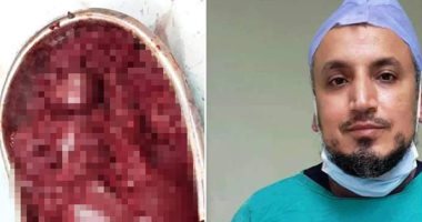 فريق طبى بمستشفى بنها للتأمين الصحى يستئصل طحال متضخم من طفل