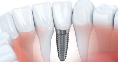 "التقويم والزراعة" تخصصات فاخرة فى طب الأسنان.. بورصة أسعار الكورسات تبدأ من 10 آلاف جنيه للتقويم وتصل لـ 500 ألف.. شكاوى من شباب الأطباء من صعوبة الالتحاق بهما.. وعضو بالنقابة: تخصصات دقيقة وتحتاج قدرات خاصة