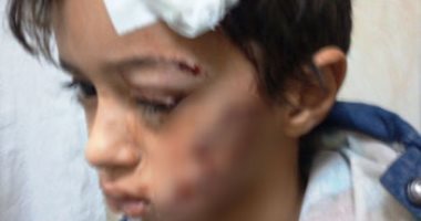 والدة طفل عقره كلب وشوه وجهه بمصر القديمة: "منهم لله بتوع حقوق الحيوان"