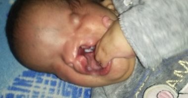 أب يستغيث بوزيرة الصحة لعلاج ابنته على نفقة الدولة من عيب خلقى 