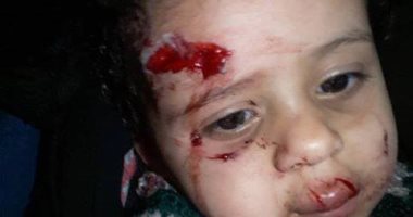 شكوى من الكلاب الضالة فى مساكن محيى الخلفاوى.. هاجمت طفلتى وأصابتها بجروح فى وجهها 