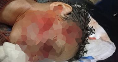 مستشفى بنها الجامعى: كلب ينهش وجه طفل.. وخضوعه لعمليات طارئة