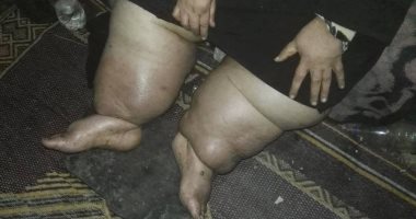 صور.. معاناة "كريمة" بكفر الشيخ.. أقعدها المرض ولا تستطيع توفير علاجها