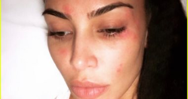 الصورة خير دليل ..ماذا فعل مرض "الصدفية " بوجه كيم كاردشيان 