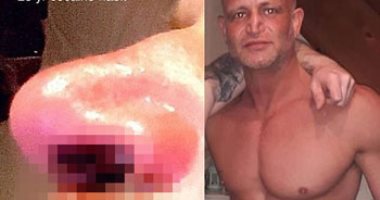 بسبب إدمانه للكوكايين.. بريطانى يتآكل أنفه بعد تعاطيه المخدر لمدة 25 عاما