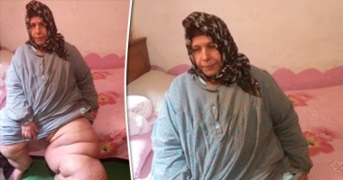 صور.. مأساة "وفاء" بالشرقية 30 عاما من الألم.. مصابة بداء الفيل وتحتاج عملية عاجلة.. وتروى: "أحنا ناس غلابة ونفسى أرجع أمشى زى الأول وأدخل الحمام.. وتؤكد: "خايفة من الصيف عشان رجلى بتسخن ومش بعرف أنام"