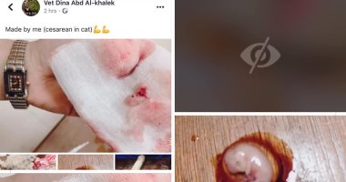 قفلت أكونتها بعد الهجوم.. طبيبة تتعرض لانتقادات لاذعة بعد عملية قيصرية لقطة